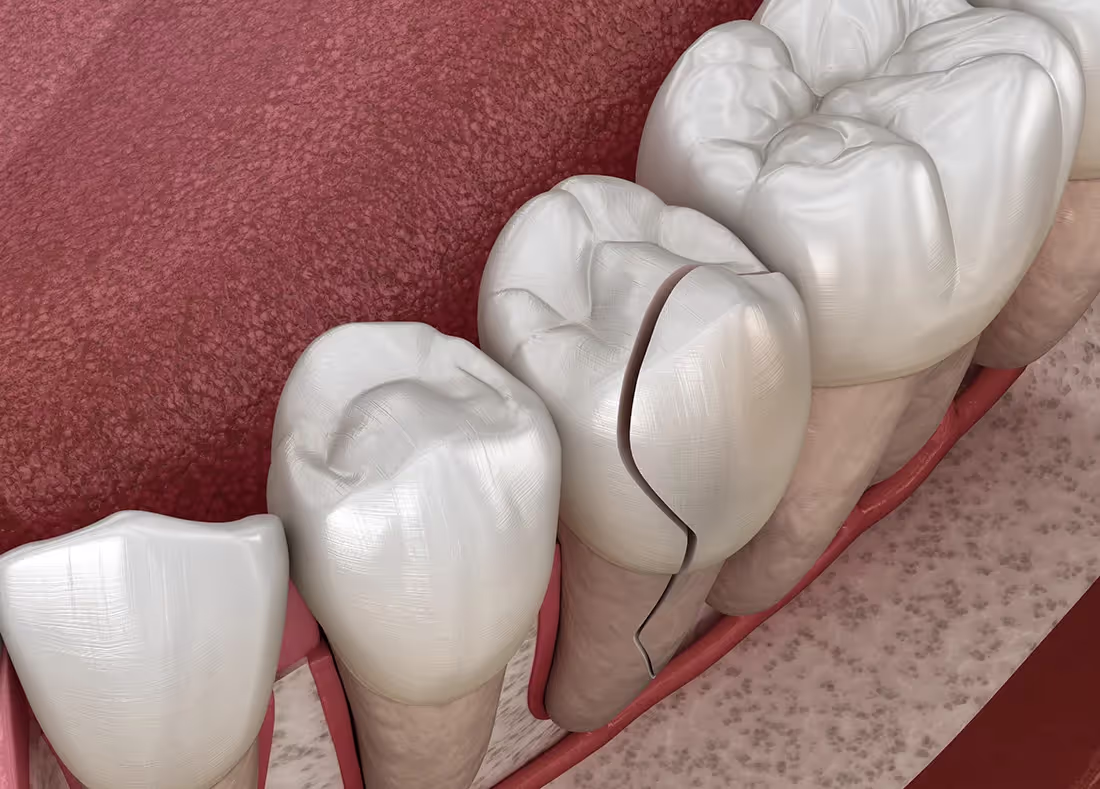Dental Emergencies in Bee Cave