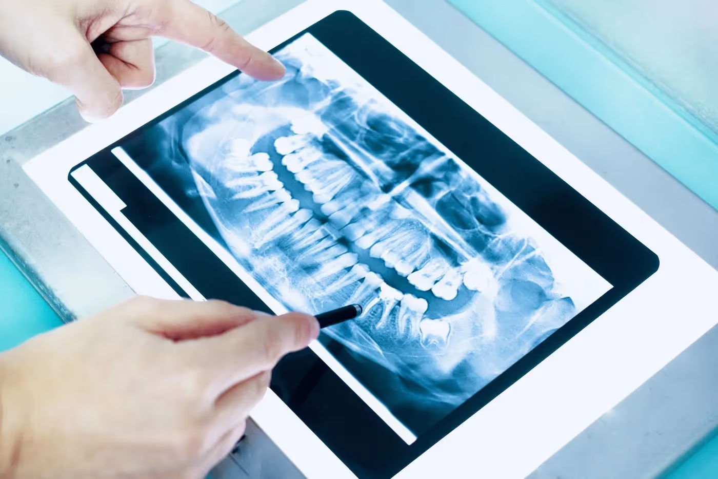 Extractions in Bee Cave, TX | Tomasik Family Dental