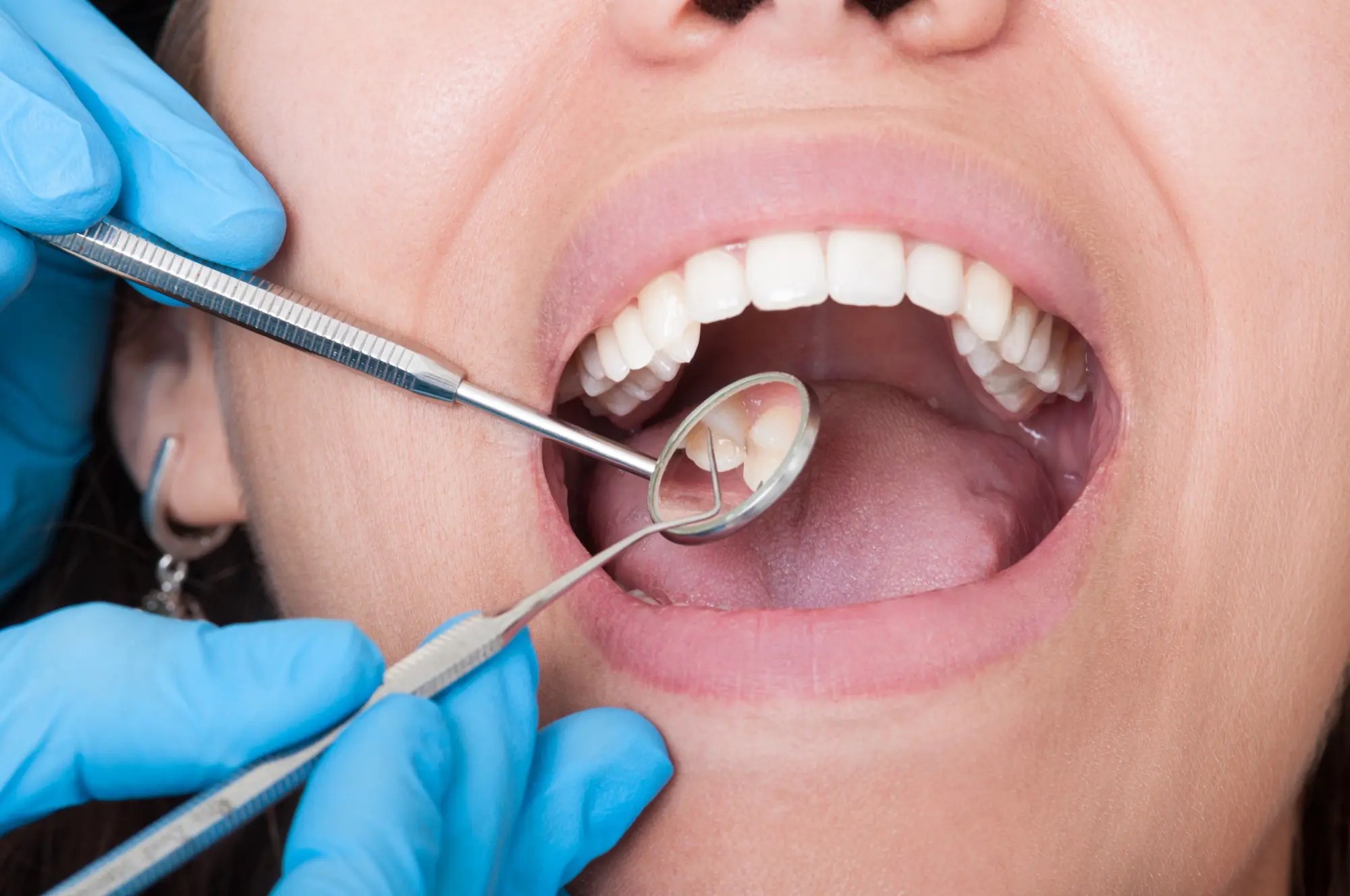 Smile Makeover in Bee Cave | Tomasik Family Dental