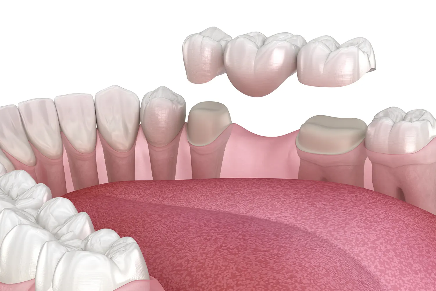 Benefit from Removable Dentures Bee Cove
